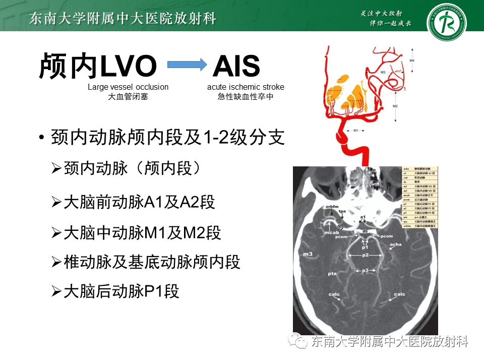 【PPT】急性缺血性脑卒中的多模态CT评估-12 【PPT】急性缺血性脑卒中的多模态CT评估-12