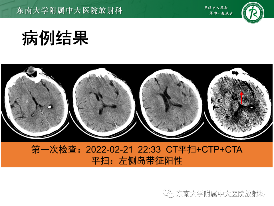 【PPT】急性缺血性脑卒中的多模态CT评估-6