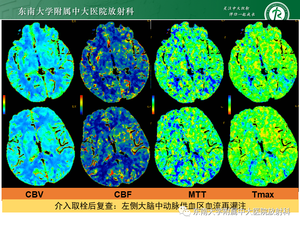 【PPT】急性缺血性脑卒中的多模态CT评估-10