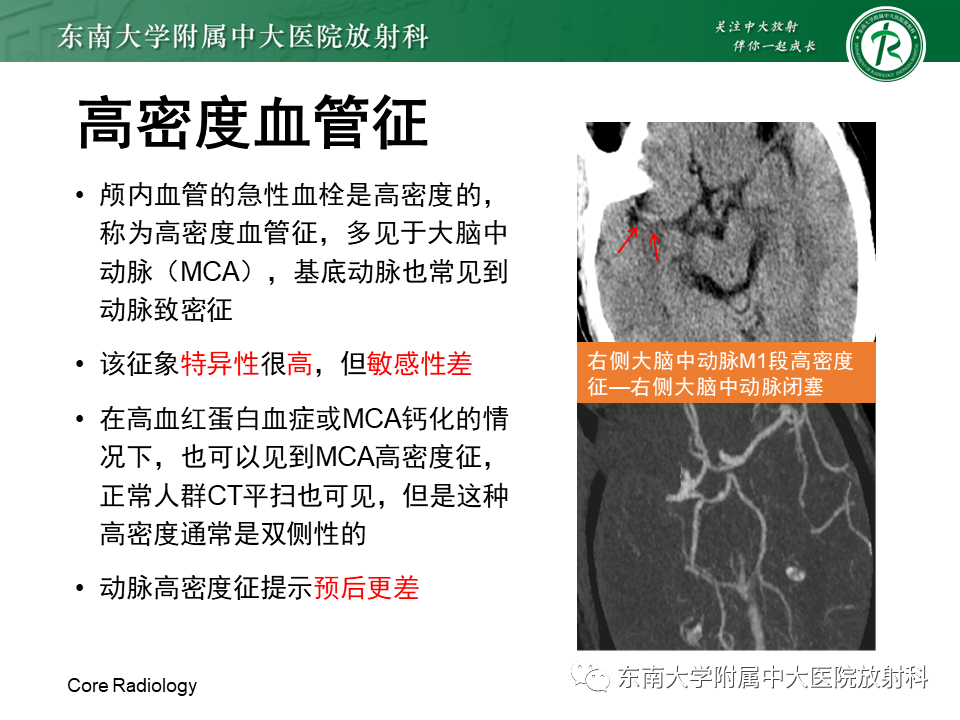 【PPT】急性缺血性脑卒中的多模态CT评估-22 【PPT】急性缺血性脑卒中的多模态CT评估-22
