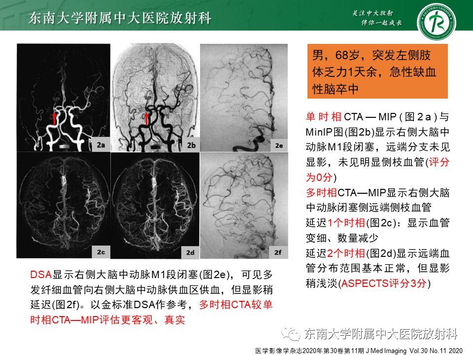 【PPT】急性缺血性脑卒中的多模态CT评估-33