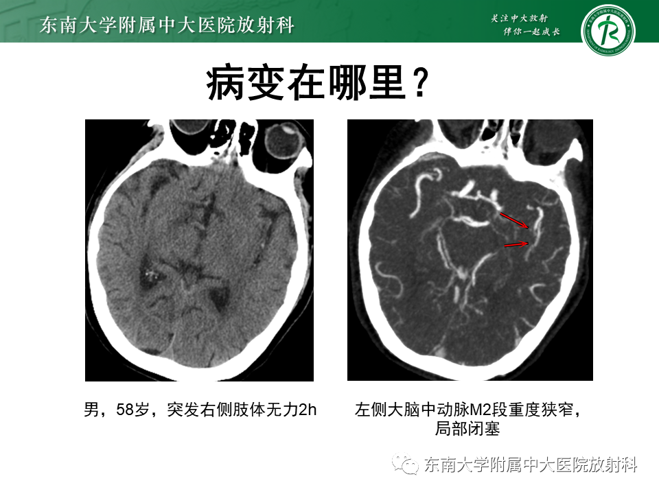 【PPT】急性缺血性脑卒中的多模态CT评估-23