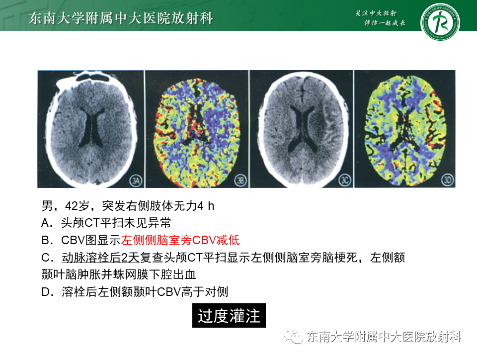 【PPT】急性缺血性脑卒中的多模态CT评估-49