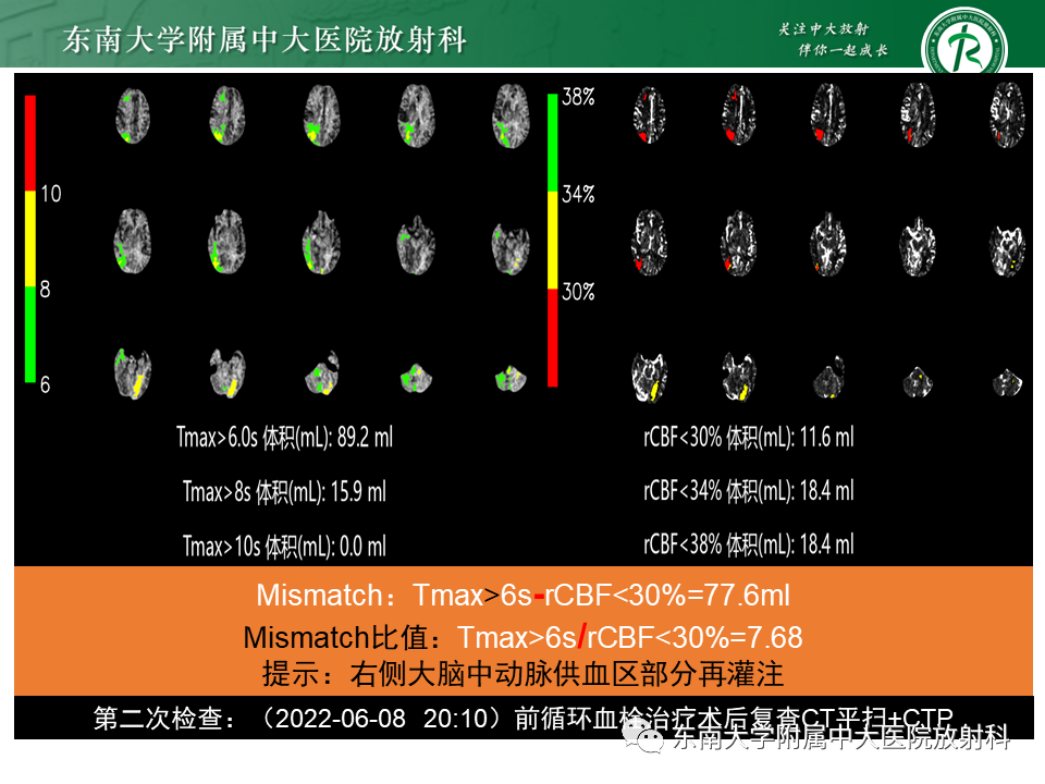 【PPT】急性缺血性脑卒中的多模态CT评估-59 【PPT】急性缺血性脑卒中的多模态CT评估-59