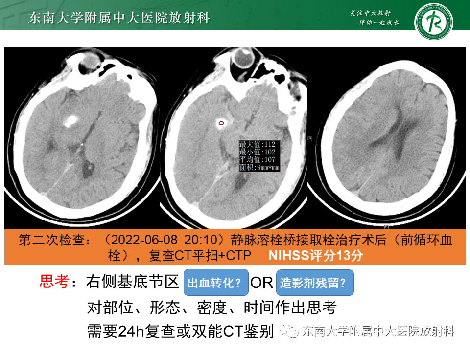 【PPT】急性缺血性脑卒中的多模态CT评估-57