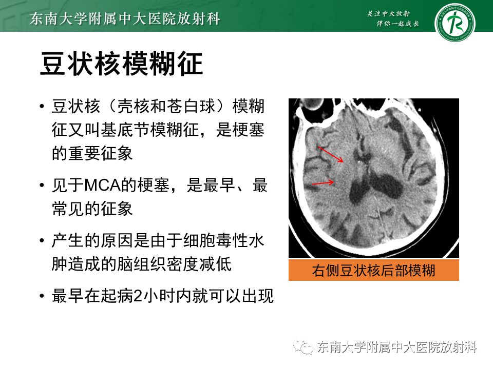 【PPT】急性缺血性脑卒中的多模态CT评估-25