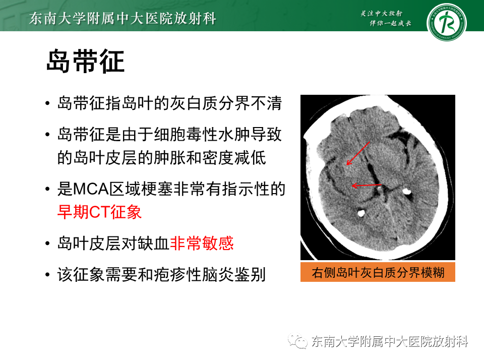 【PPT】急性缺血性脑卒中的多模态CT评估-26 【PPT】急性缺血性脑卒中的多模态CT评估-26