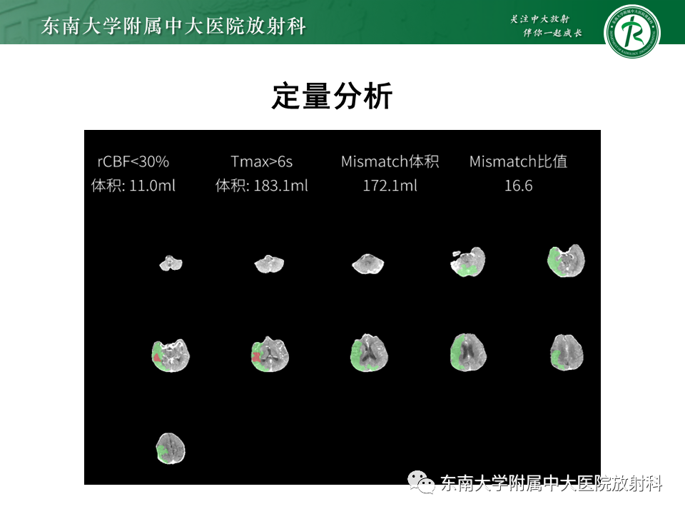 【PPT】急性缺血性脑卒中的多模态CT评估-43 【PPT】急性缺血性脑卒中的多模态CT评估-43