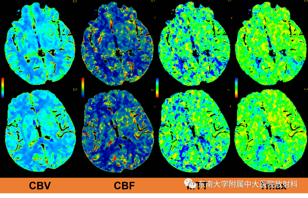【PPT】急性缺血性脑卒中的多模态CT评估-5
