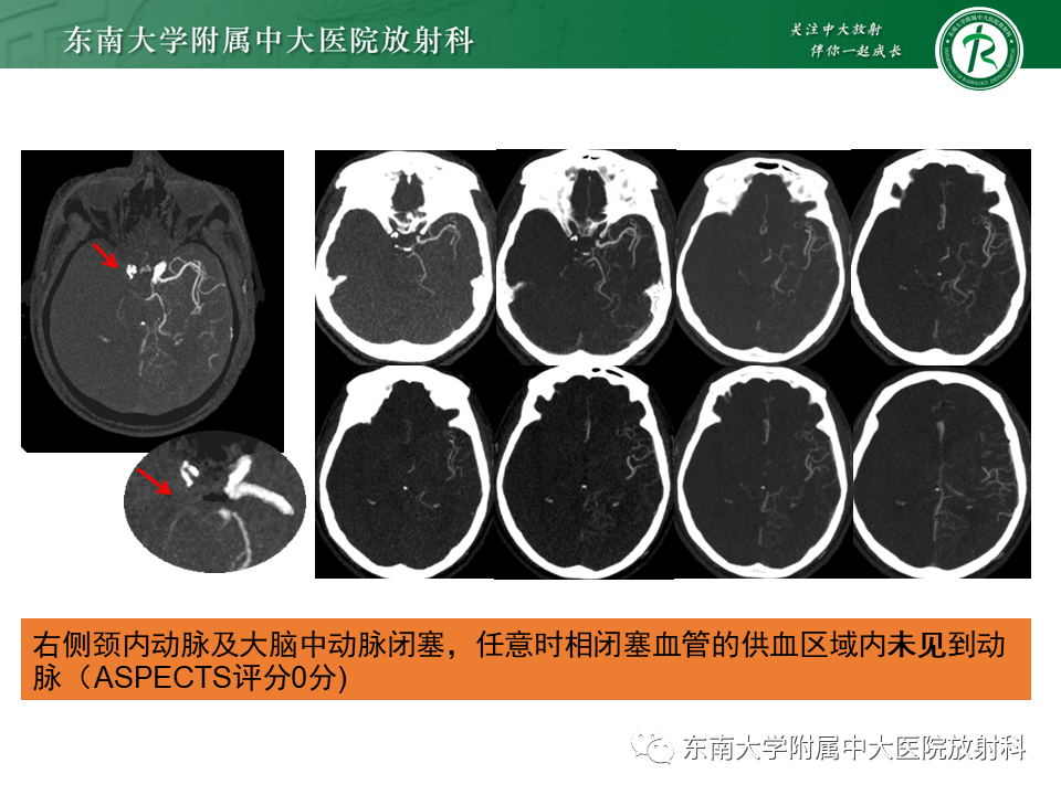 【PPT】急性缺血性脑卒中的多模态CT评估-34