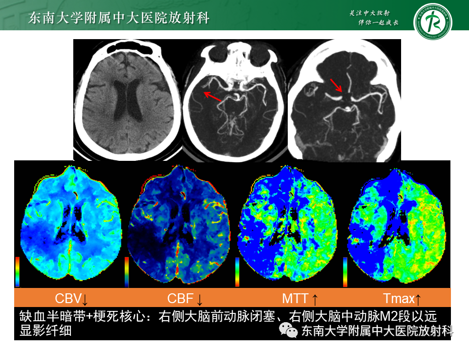 【PPT】急性缺血性脑卒中的多模态CT评估-47