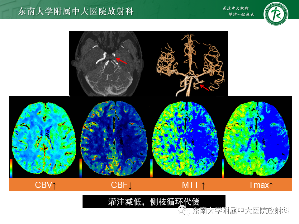 【PPT】急性缺血性脑卒中的多模态CT评估-46
