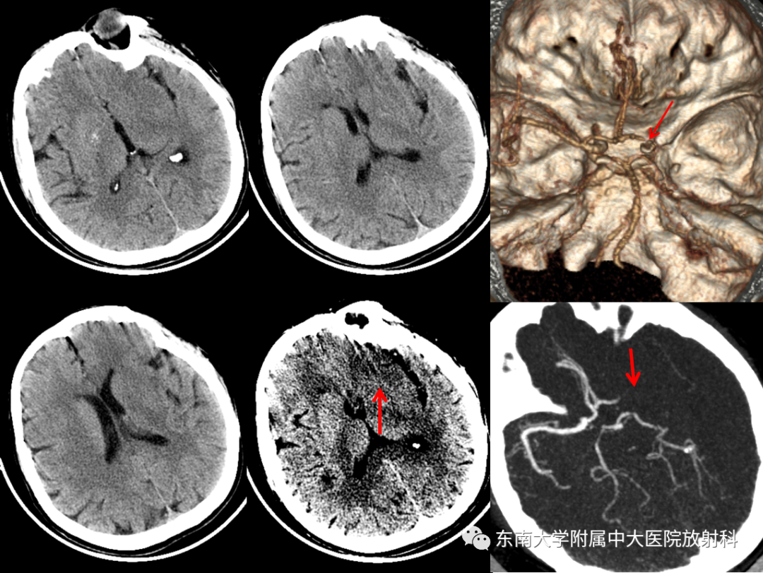 急性缺血性脑卒中的多模态CT评估