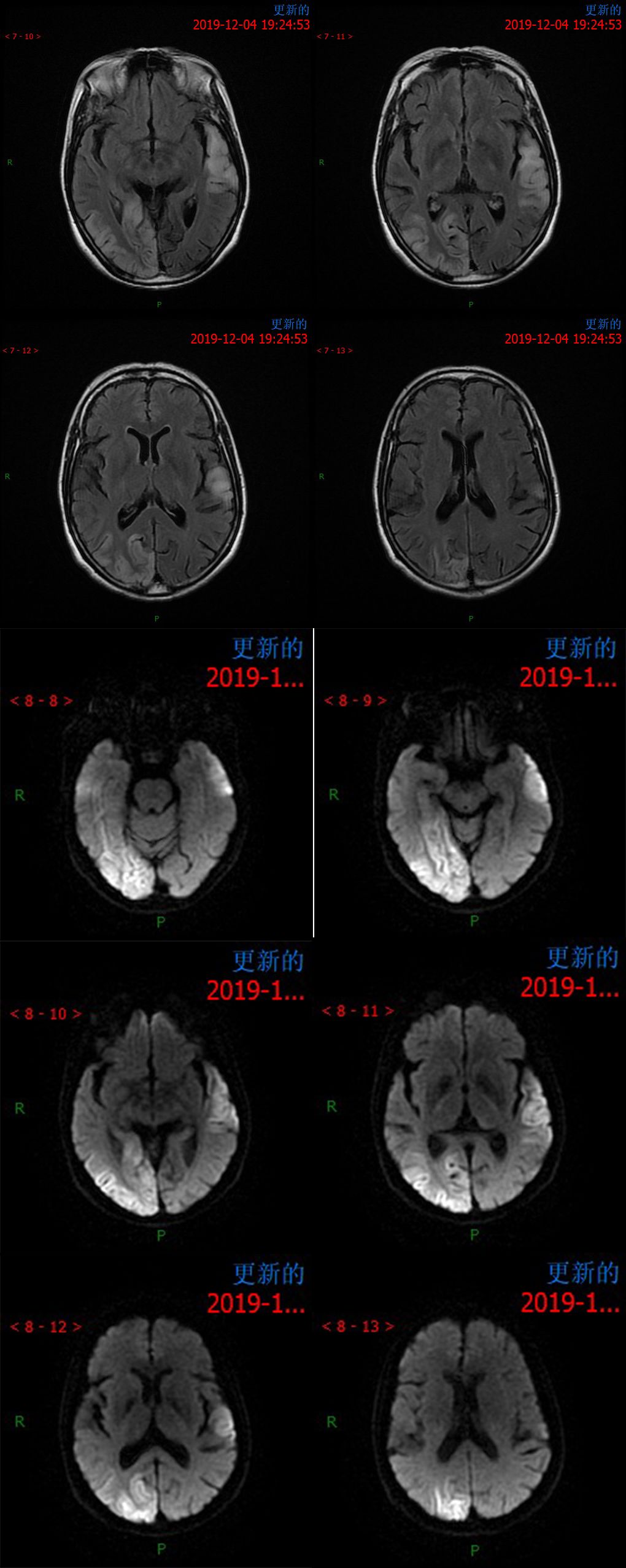 【病例】MELAS线粒体脑肌病伴高乳酸血症和卒中样发作综合征一例MR-2
