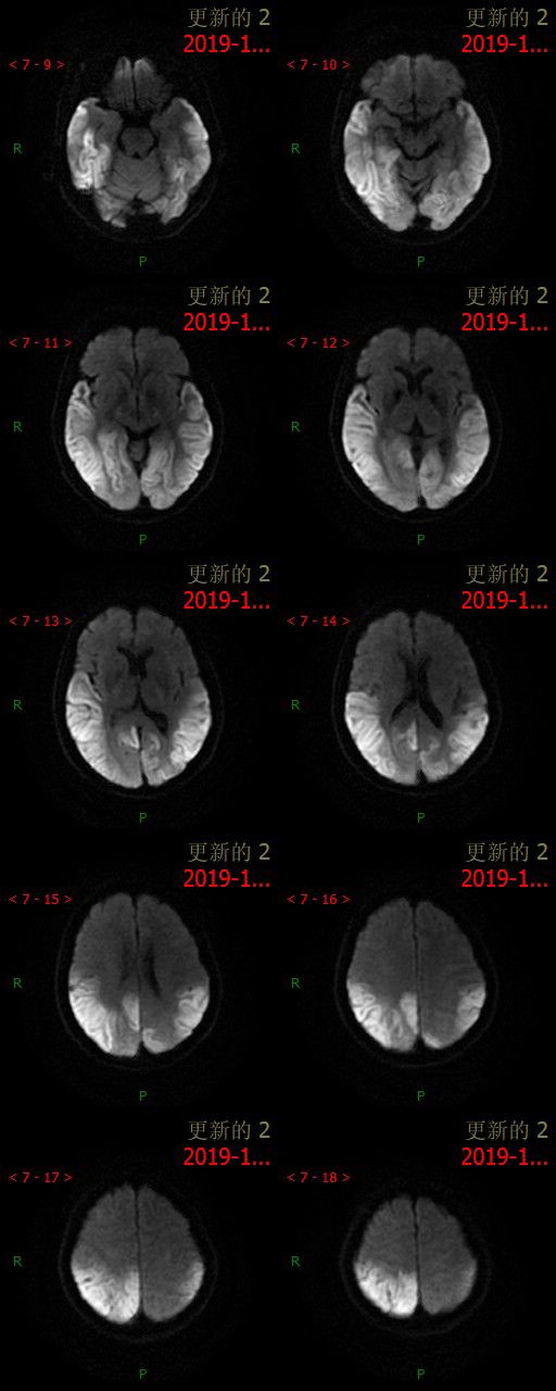【病例】MELAS线粒体脑肌病伴高乳酸血症和卒中样发作综合征一例MR-5