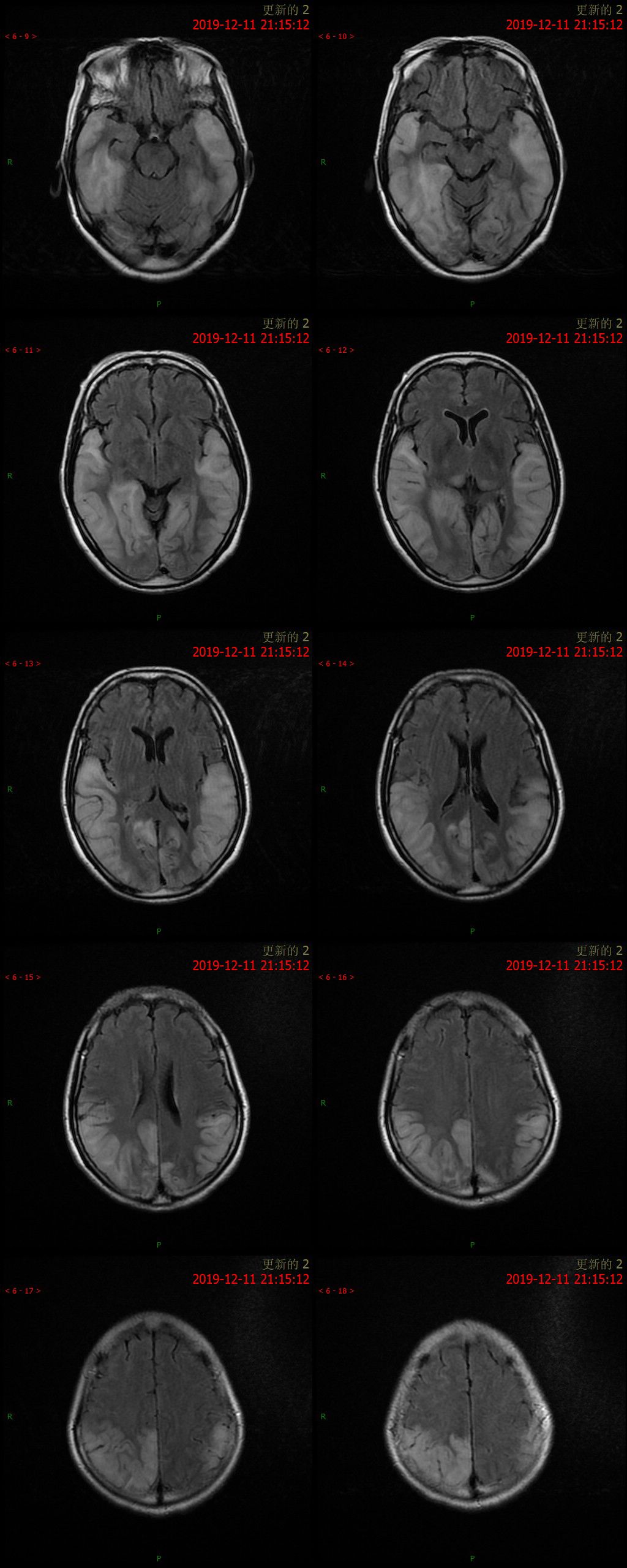 【病例】MELAS线粒体脑肌病伴高乳酸血症和卒中样发作综合征一例MR-4