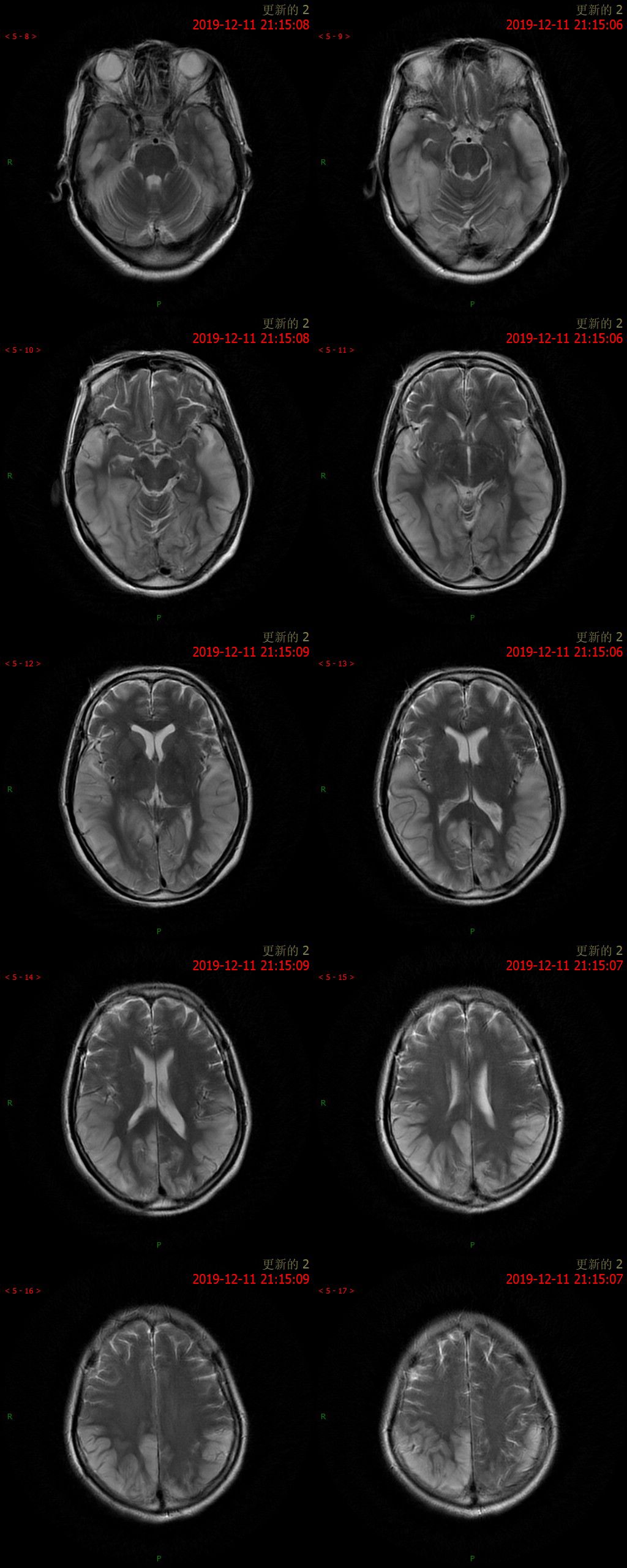 【病例】MELAS线粒体脑肌病伴高乳酸血症和卒中样发作综合征一例MR-3