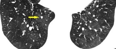 高密度病变肺HRCT基本解释-6