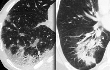高密度病变肺HRCT基本解释-9