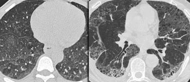高密度病变肺HRCT基本解释-2