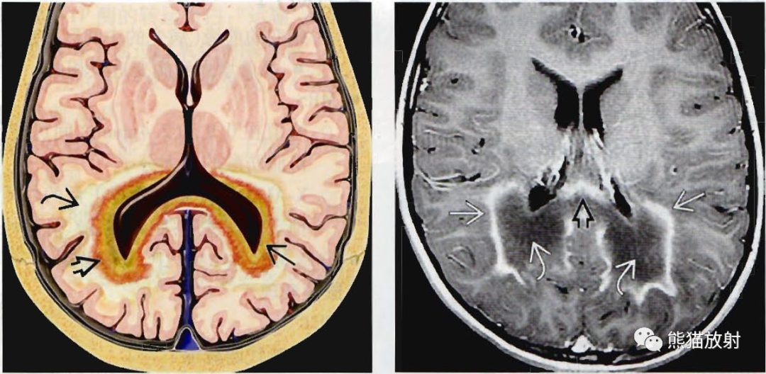 肾上腺脑白质营养不良影像诊断要点-1