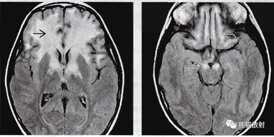 肾上腺脑白质营养不良影像诊断要点-4