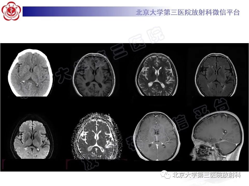 【PPT】脉络丛黄色肉芽肿-3