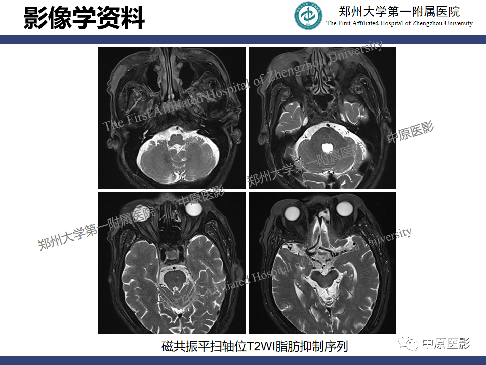 【病例】眼眶周围淋巴瘤1例CT及MR-4