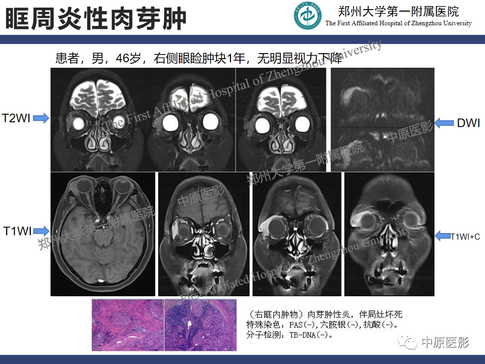 【病例】眼眶周围淋巴瘤1例CT及MR-17