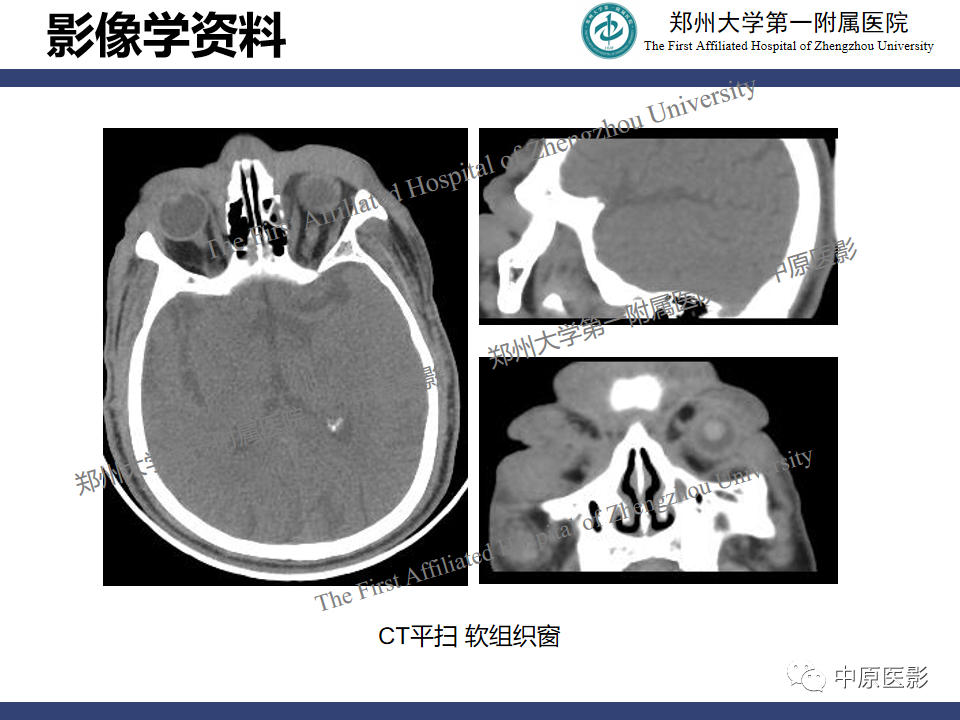 【病例】眼眶周围淋巴瘤1例CT及MR-7