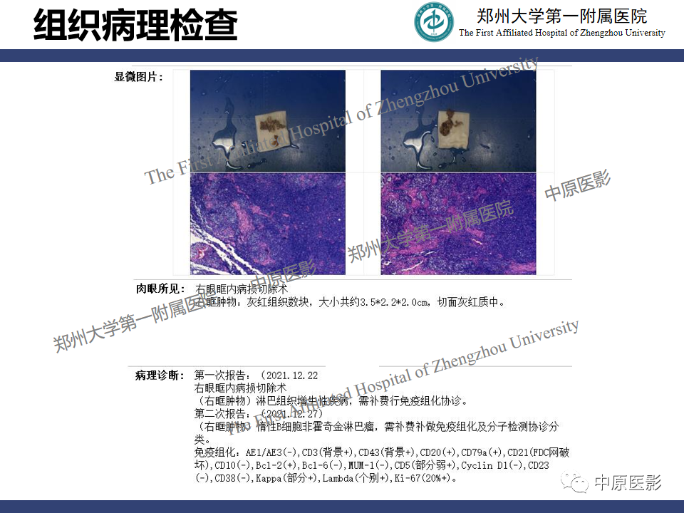 【病例】眼眶周围淋巴瘤1例CT及MR-10