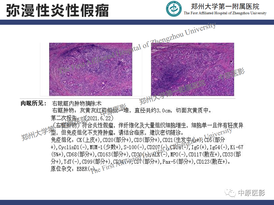 【病例】眼眶周围淋巴瘤1例CT及MR-23
