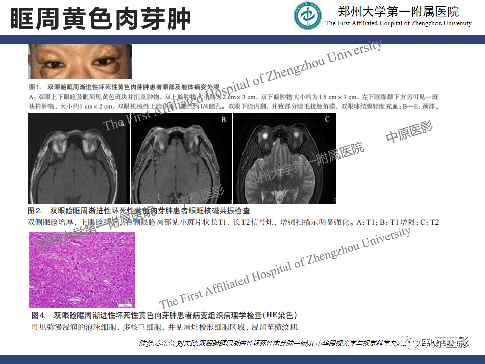 【病例】眼眶周围淋巴瘤1例CT及MR-19