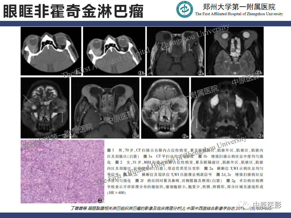【病例】眼眶周围淋巴瘤1例CT及MR-14