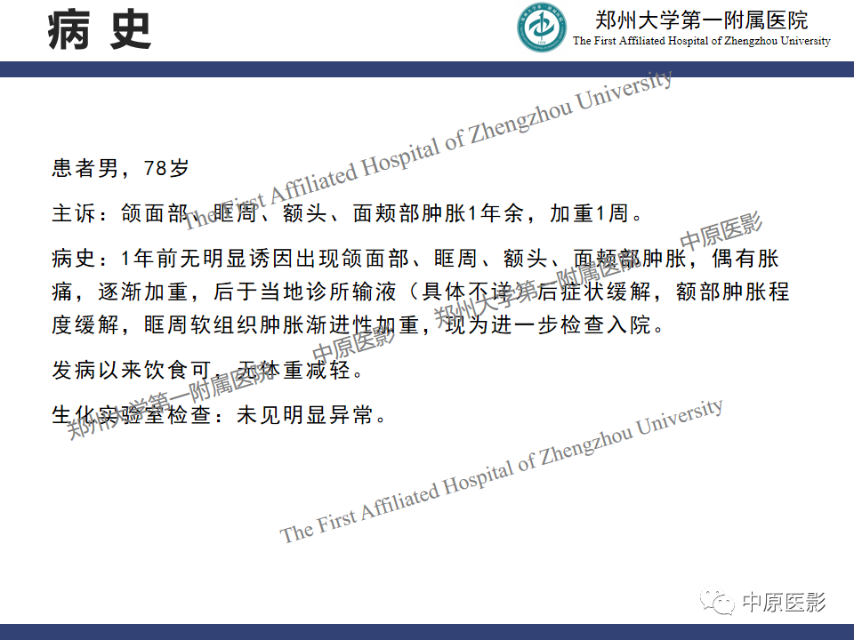 【病例】眼眶周围淋巴瘤1例CT及MR-2