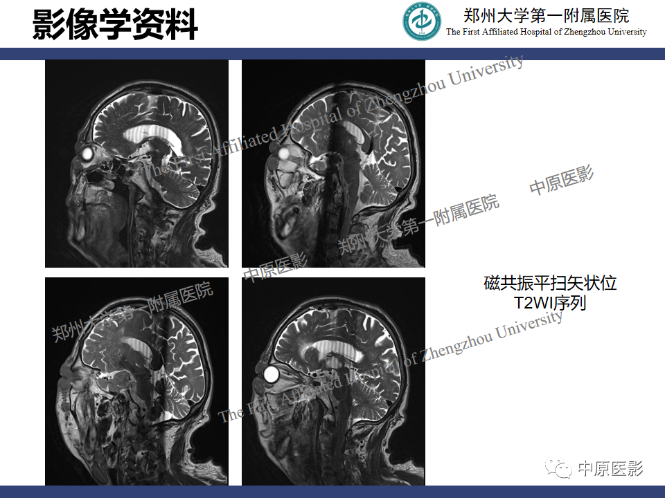 【病例】眼眶周围淋巴瘤1例CT及MR-5