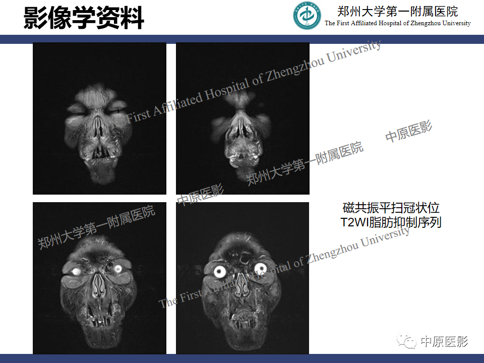 【病例】眼眶周围淋巴瘤1例CT及MR-6