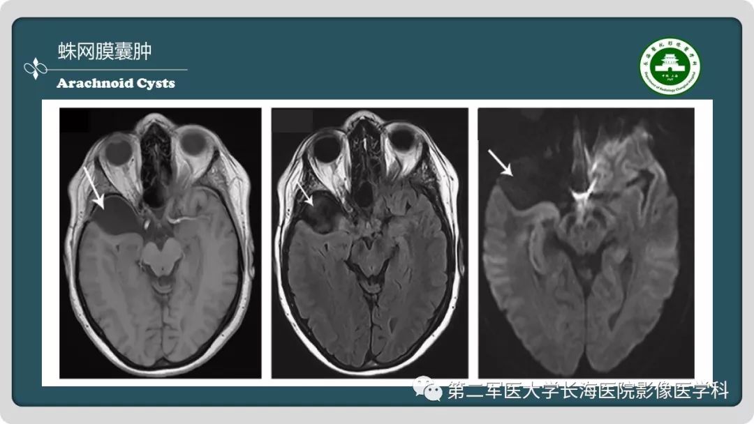 【PPT】颅内囊性病变影像表现-81