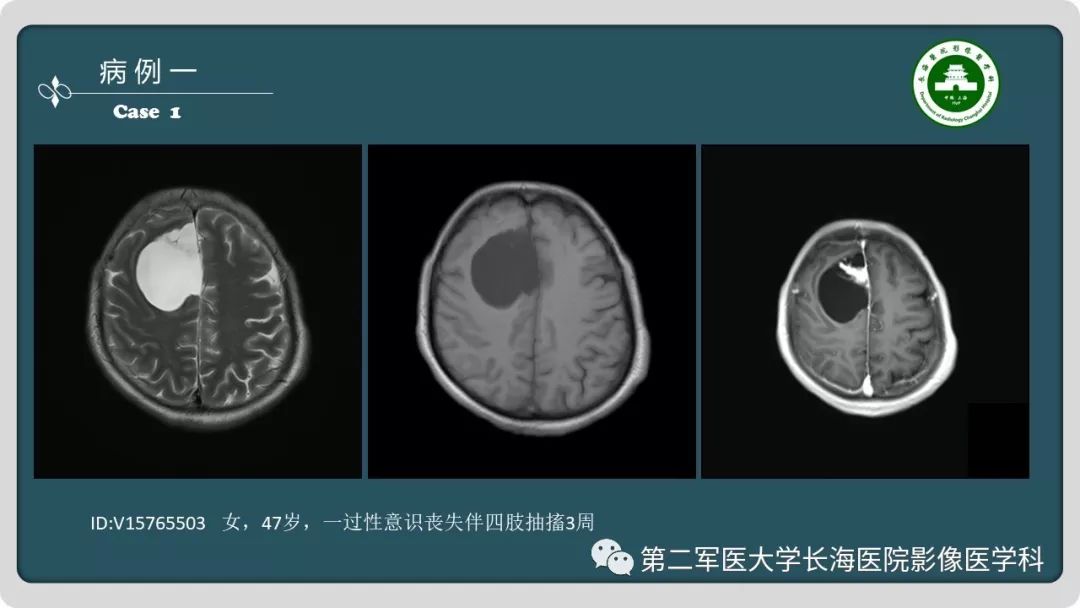 【PPT】颅内囊性病变影像表现-2