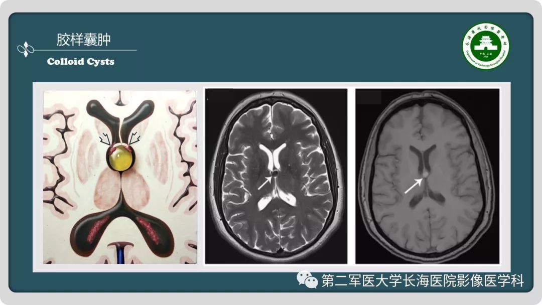 【PPT】颅内囊性病变影像表现-52