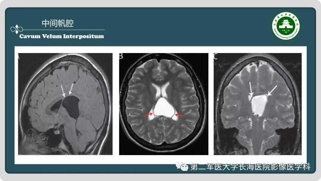 【PPT】颅内囊性病变影像表现-62