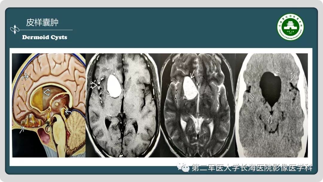 【PPT】颅内囊性病变影像表现-66