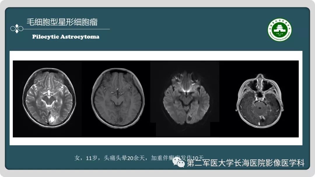 【PPT】颅内囊性病变影像表现-41