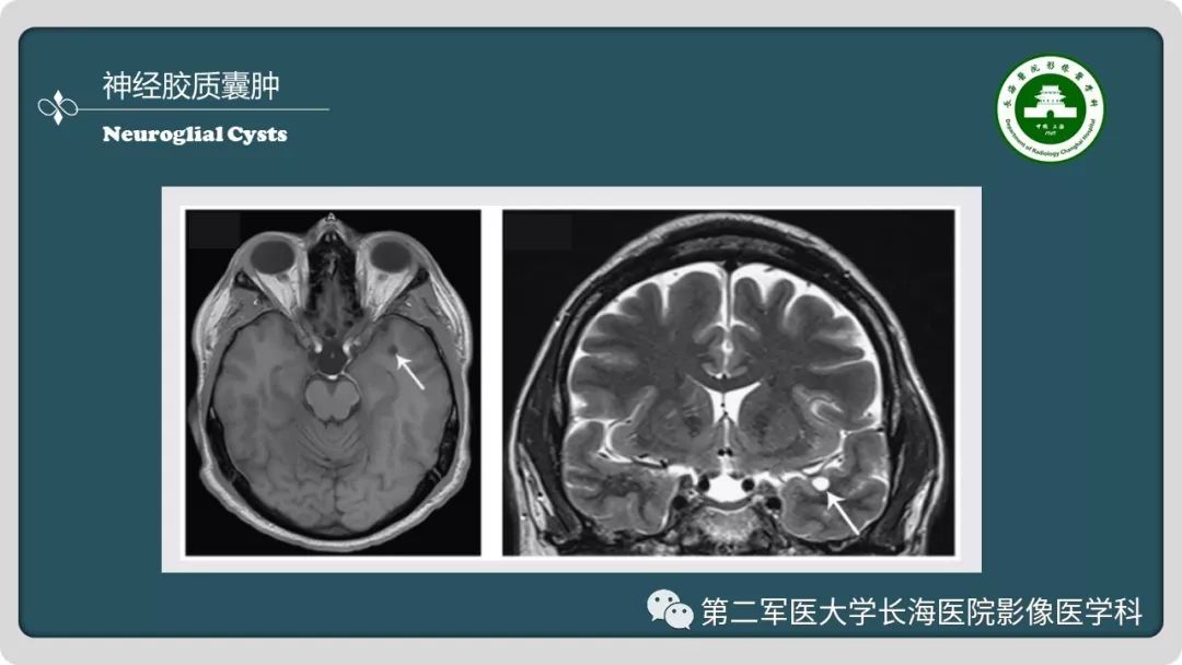 【PPT】颅内囊性病变影像表现-29