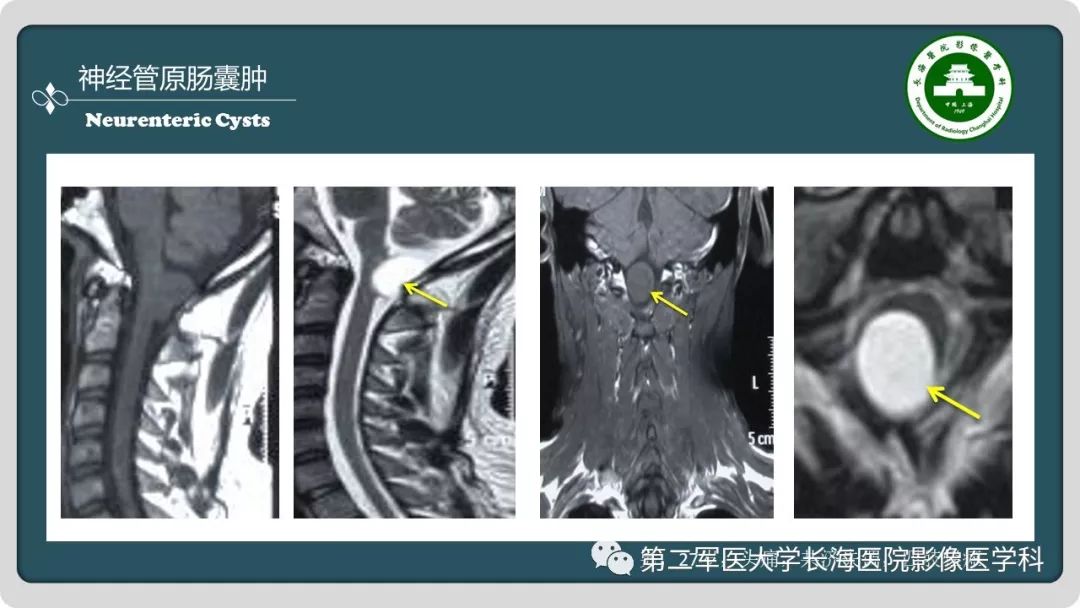 【PPT】颅内囊性病变影像表现-65