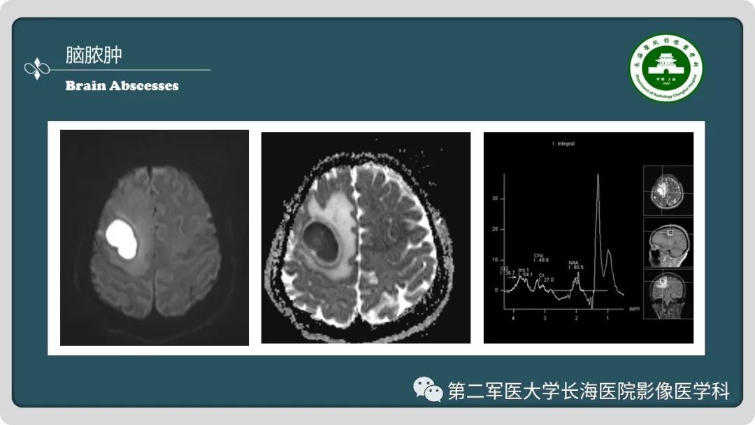 【PPT】颅内囊性病变影像表现-34