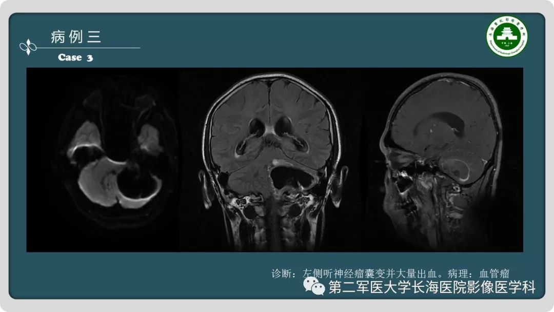 【PPT】颅内囊性病变影像表现-8