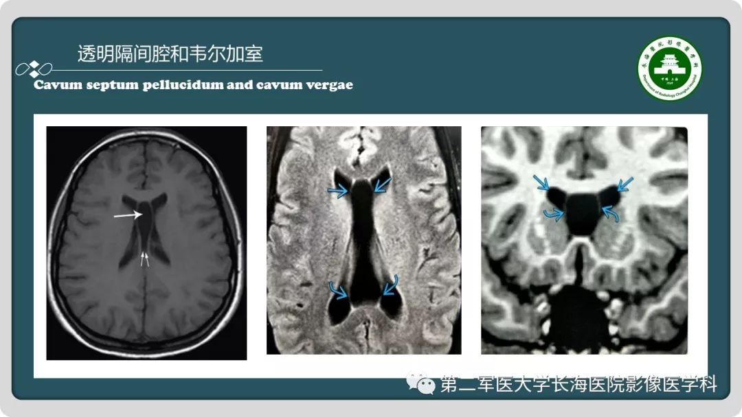 【PPT】颅内囊性病变影像表现-60