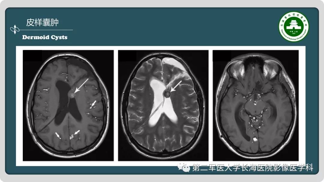 【PPT】颅内囊性病变影像表现-67