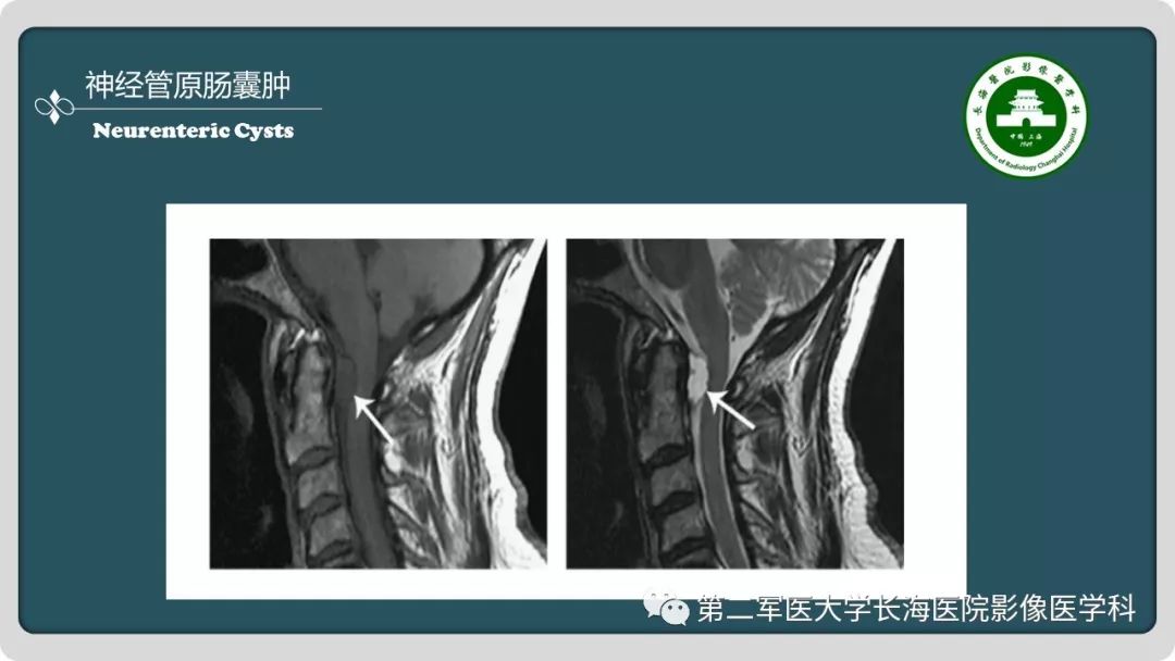 【PPT】颅内囊性病变影像表现-64